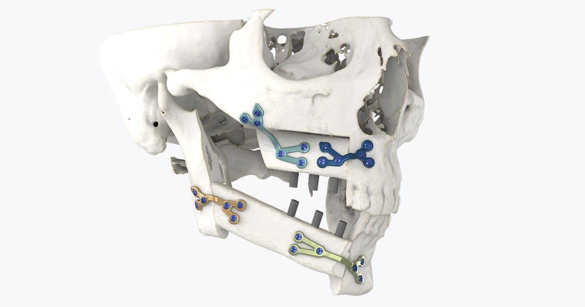 Reconstructive Surgery Cranio Maxillofacial Solutions Materialise