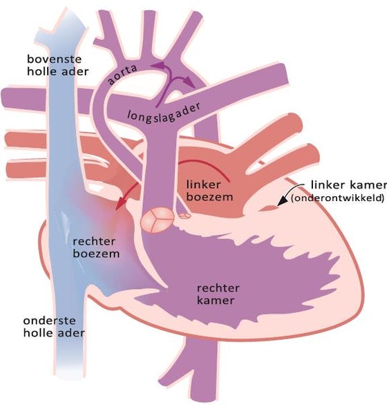 Hypoplastisch Linkerhartsyndroom Centrum Voor Aangeboren