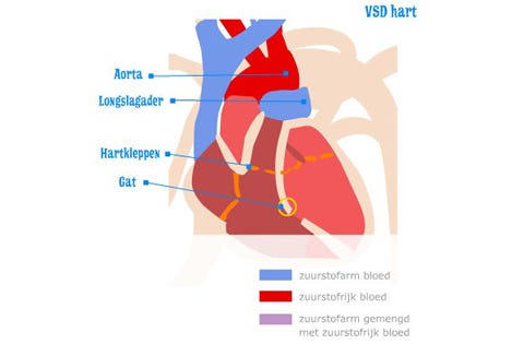 Vsd Ventrikelseptumdefect Gaatje In Het Hart Het Wkz