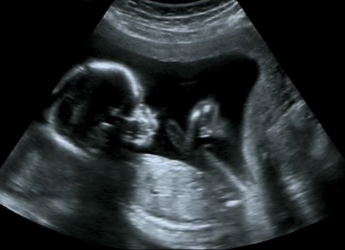 Mijn baby groeit niet goed - Het WKZ