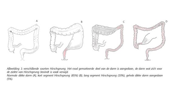 Ziekte Van Hirschsprung Op Latere Leeftijd