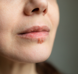 Frau mit Herpes