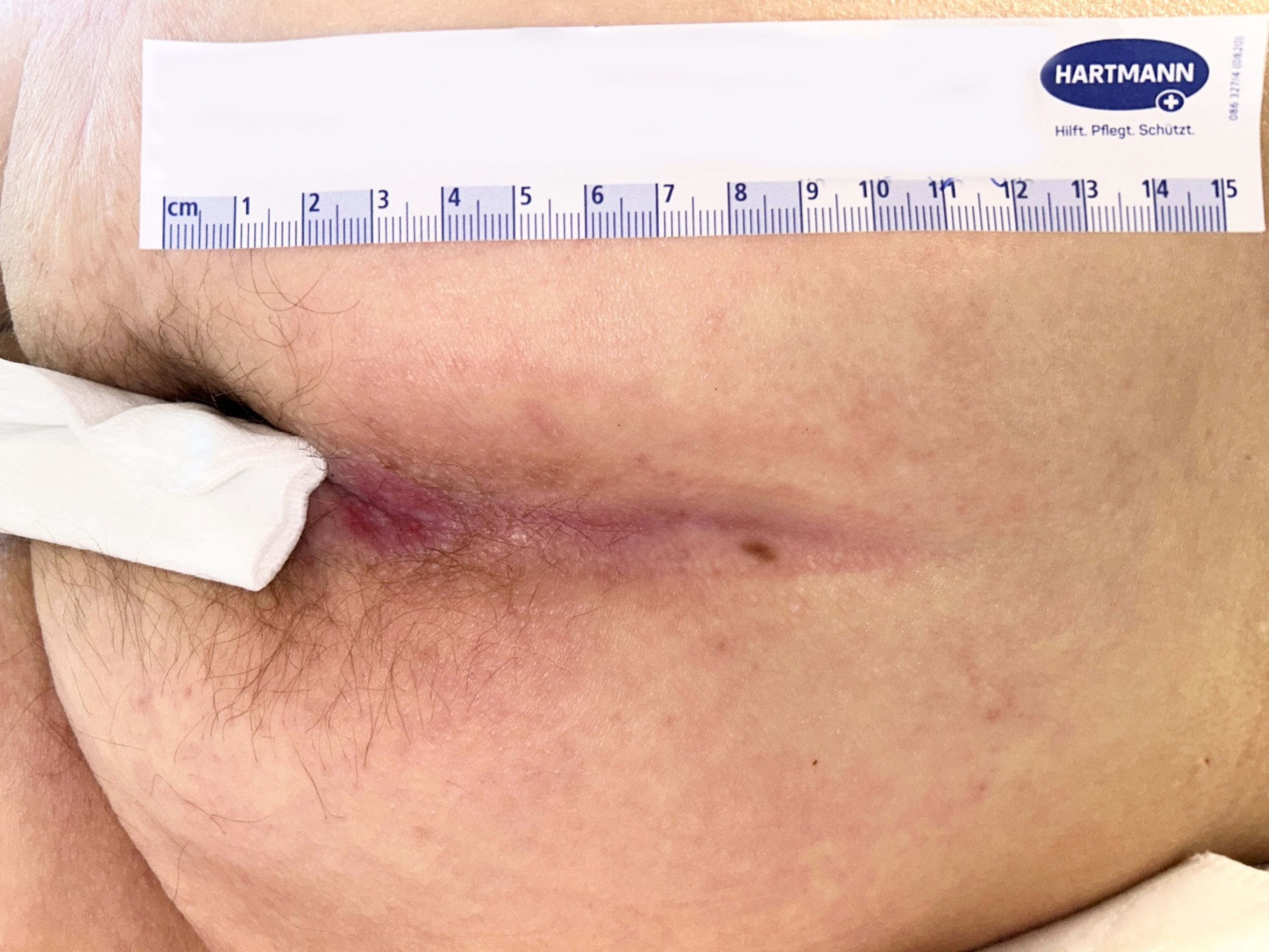 Fig. 3: Risultato finale e guarigione dopo soli quattro giorni con una sola medicazione Zetuvit Plus Silicone Border Sacrum.