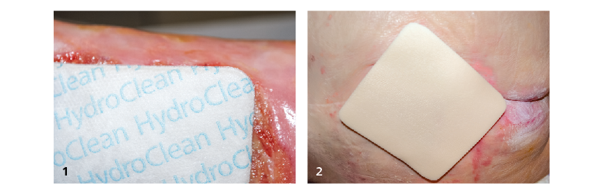 Praxistipp Wundbehandlung