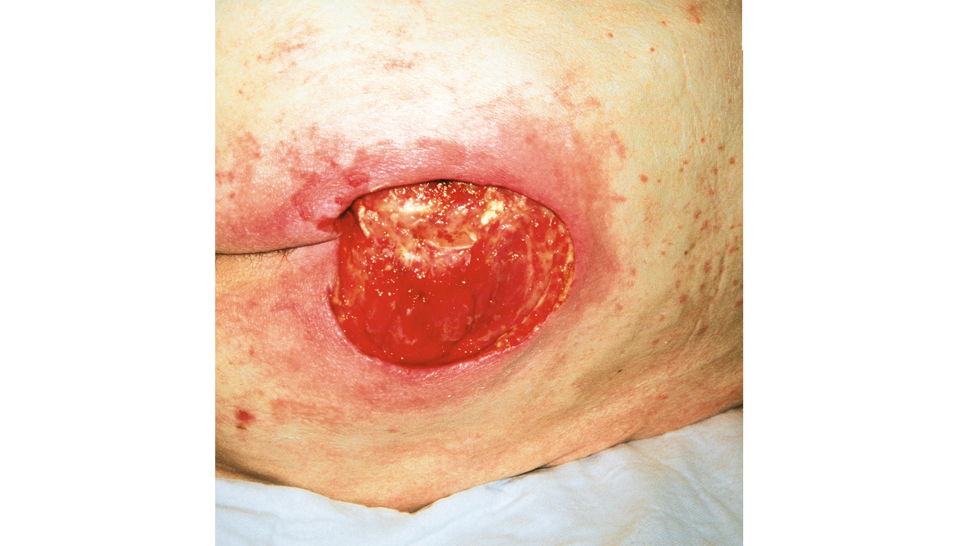 Malnutrition_Dekubitus