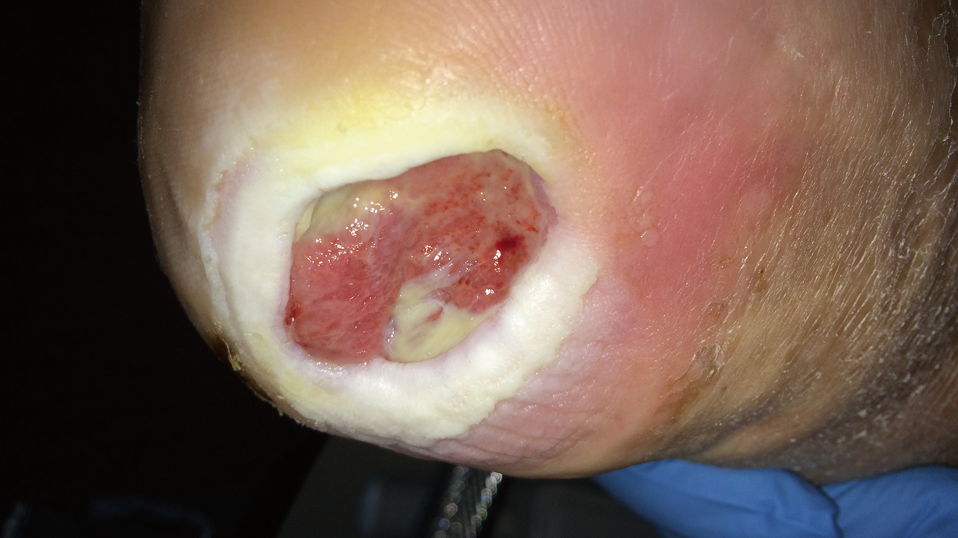 Diabetisches Fusssyndrom