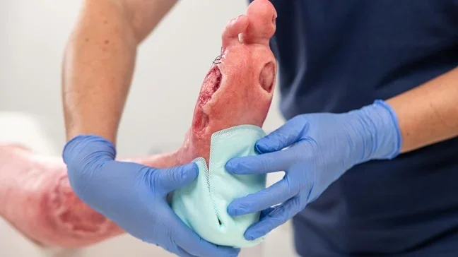 Anwendung der Wundauflage Zetuvit Plus