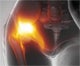 Hip Replacement Register