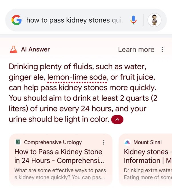 Kidney stone AI