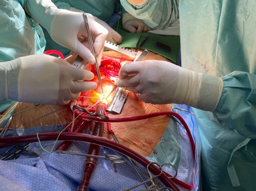 Detail Herzoperation