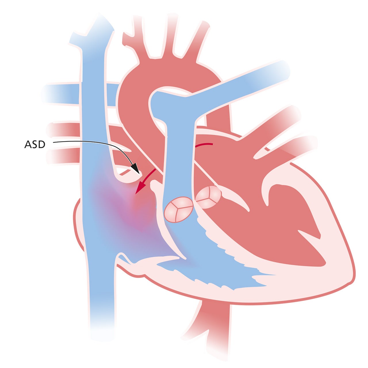 Hart met een atriumseptumdefect (ASD)