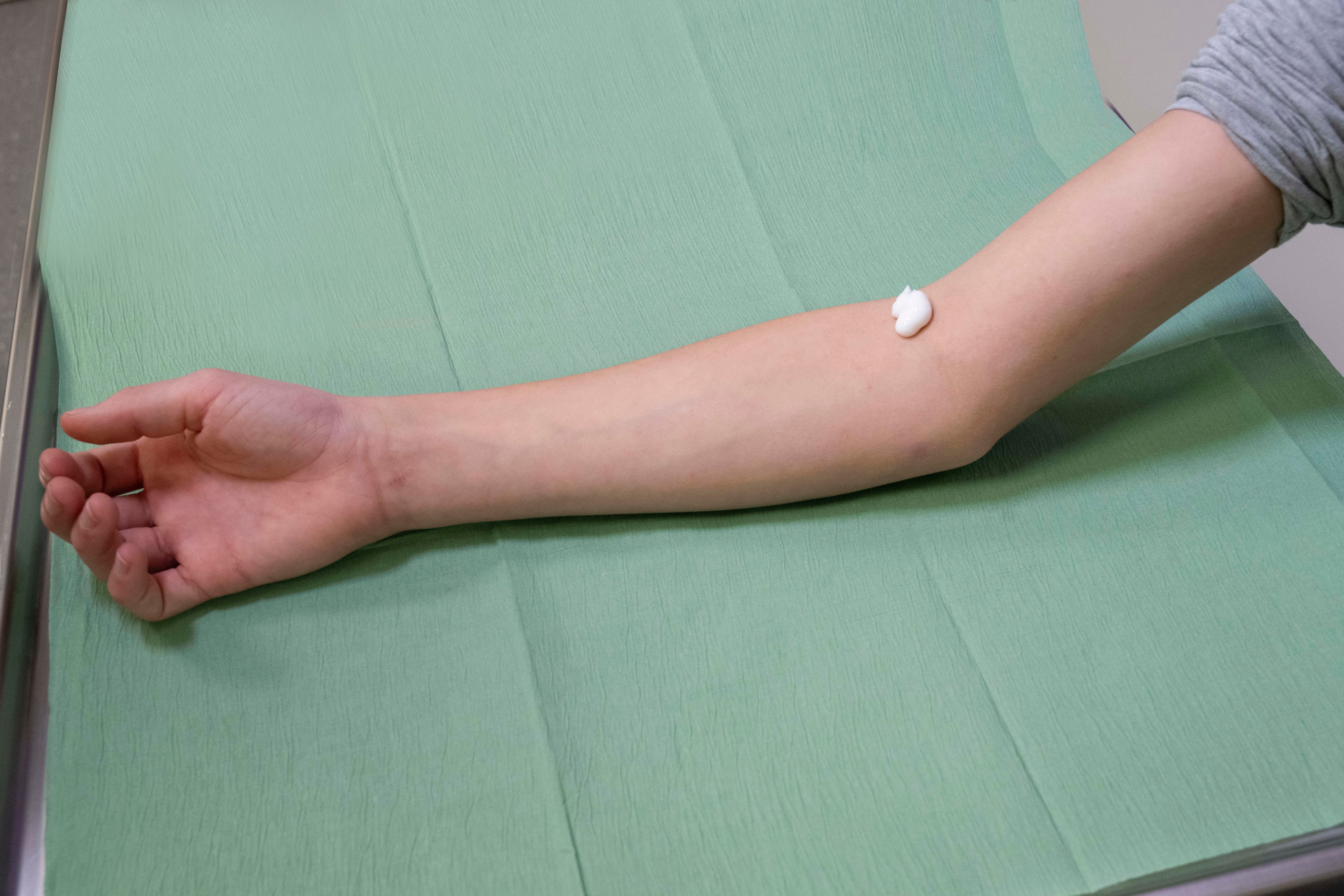 klodder zalf op elleboog