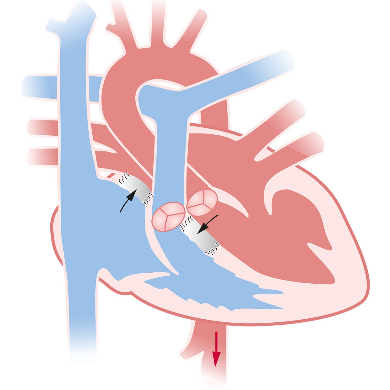 AVSD met geslotn defecten