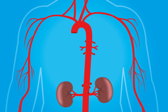 Interventieradiologie bij vaatlijden - UMC Utrecht
