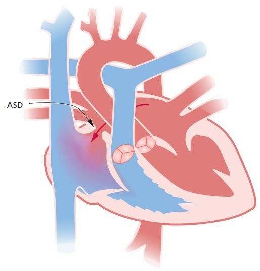 Atriumseptumdefect (ASD) Centrum aangeboren hartafwijkingen UMC Utrecht Het WKZ