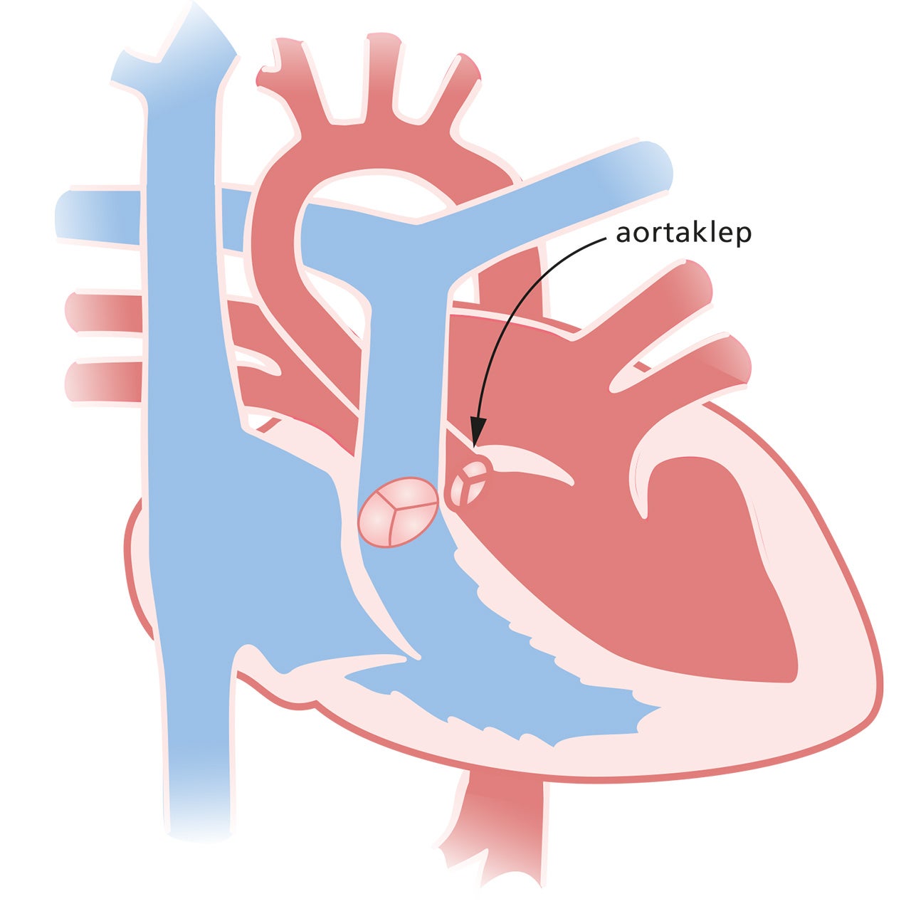 Hart met aortaklepstenose