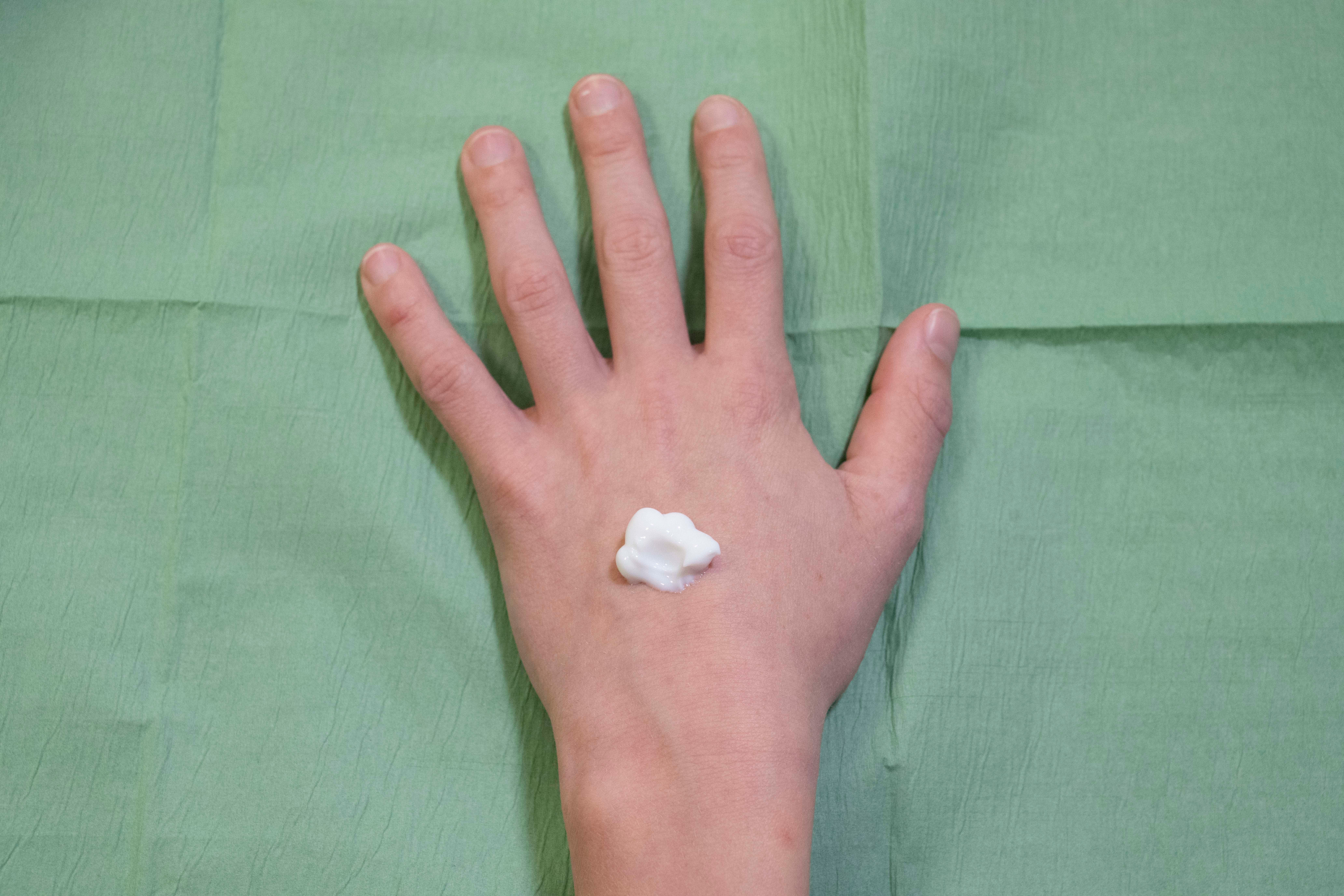 klodder EMLA op hand