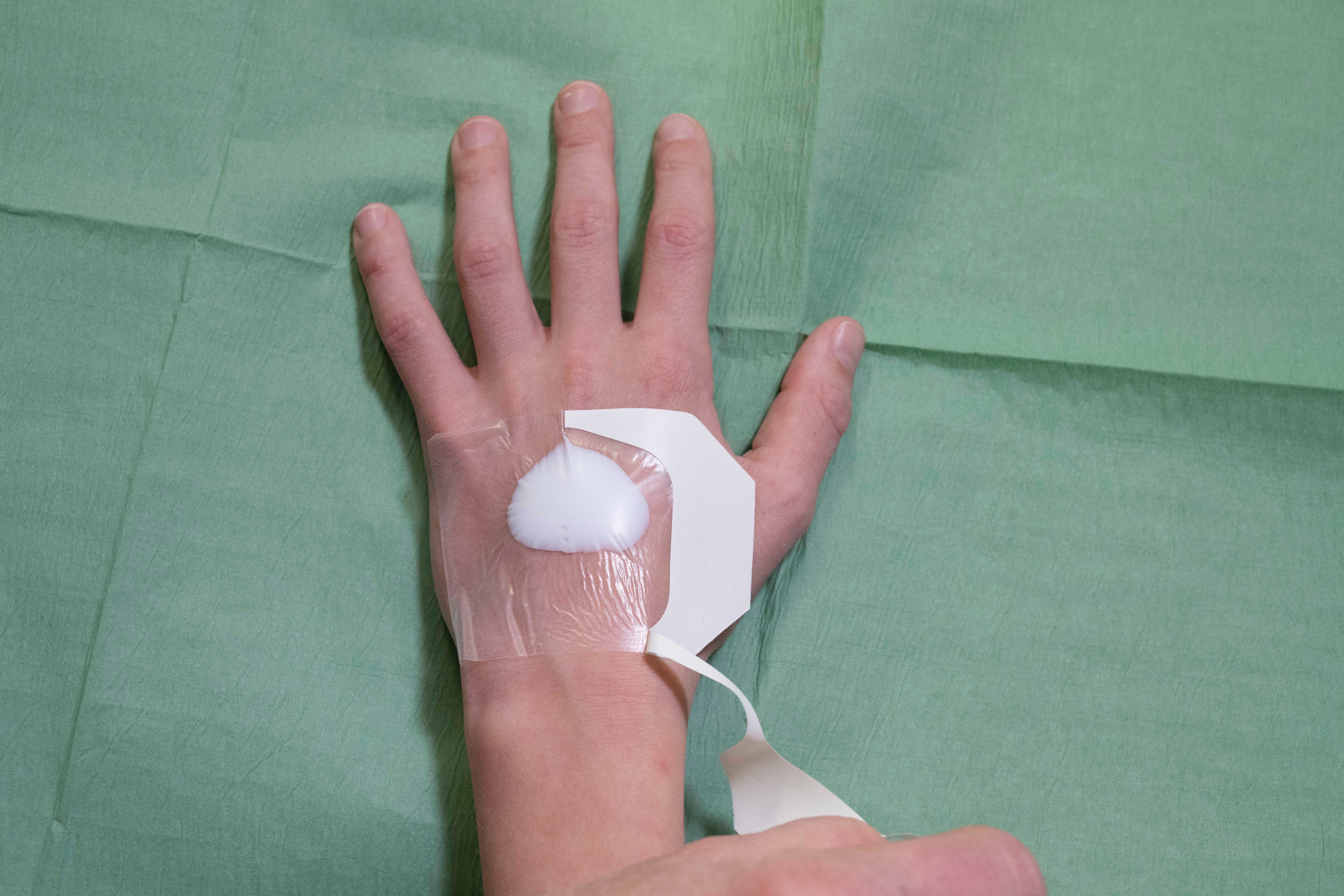 randje pleister EMLA verwijderen hand