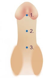Drie van de mogelijke openingen bij een hypospadie