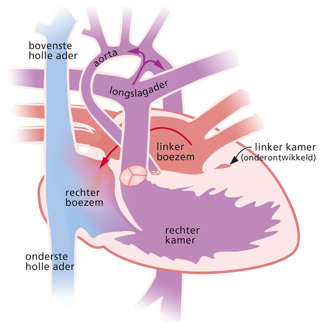 hypoplastisch linkerhartsyndroom