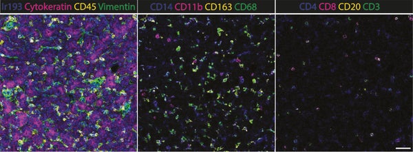 Myeloïde immuuncellen zijn veel aanwezig in hepatoblastoom  

Met een speciale beeldtechniek (imaging mass cytometry) hebben we immuuncellen zichtbaar gemaakt in hepatoblastoom weefsel. Links ziet u een overzicht van de structuur van de tumor, waarbij de immuuncellen geel gekleurd zijn (CD45). In het midden is te zien dat er veel myeloïde cellen aanwezig zijn in de tumor. Rechts ziet u dat T-cellen (CD3 - groen) daarentegen bijna helemaal ontbreken.  