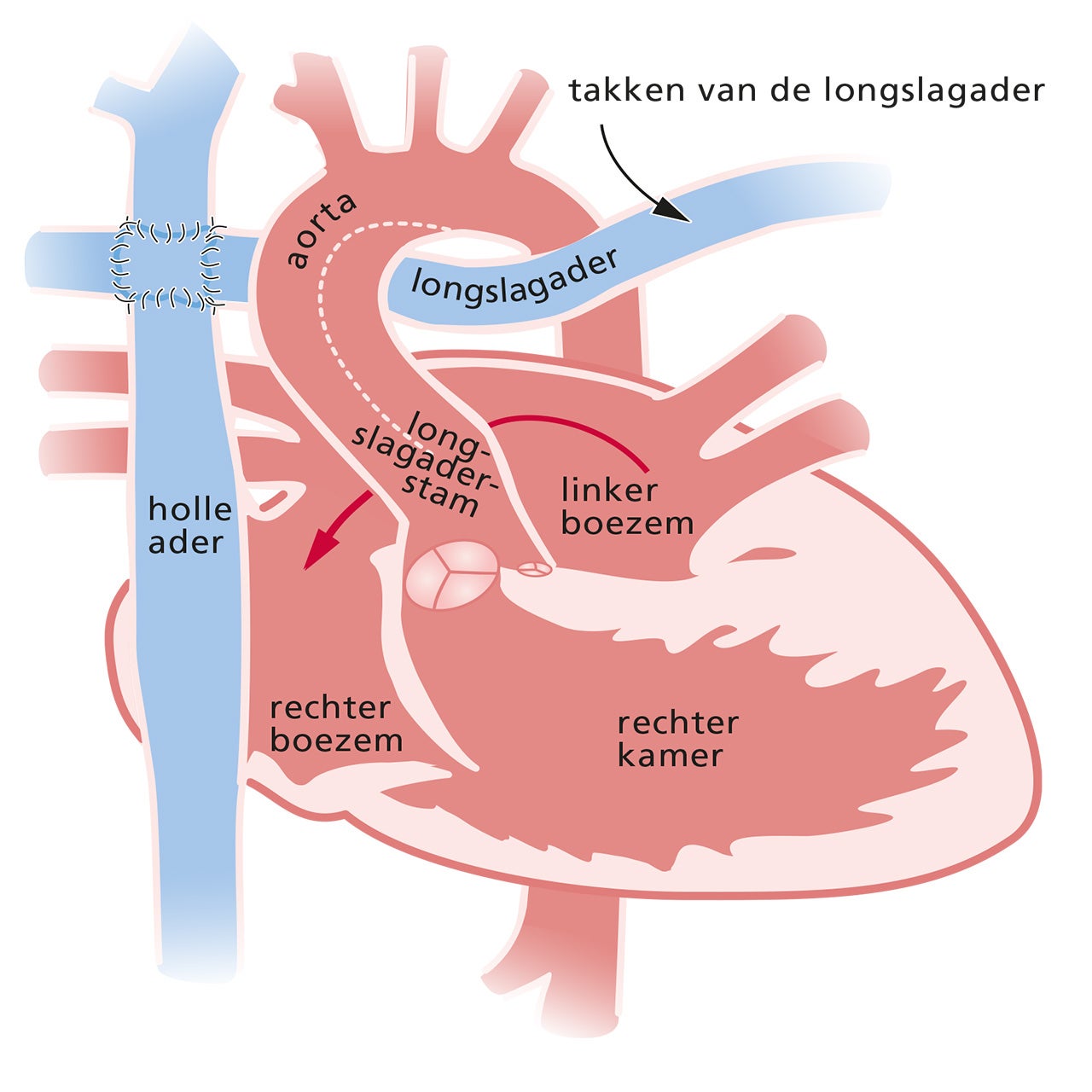 Het hart met een hypoplastisch linkerhartsyndroom na een Fontan-operatie (TCPC)