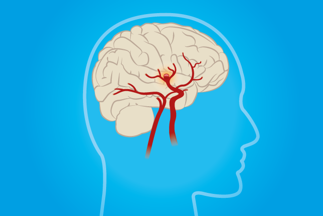 Interventieradiologie bij neuro-interventies - UMC Utrecht