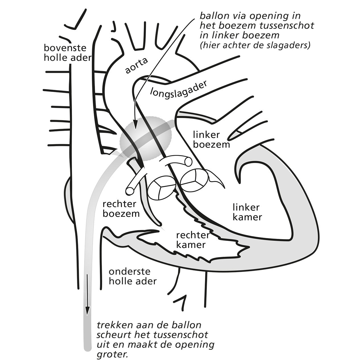 De Rashkind procedure