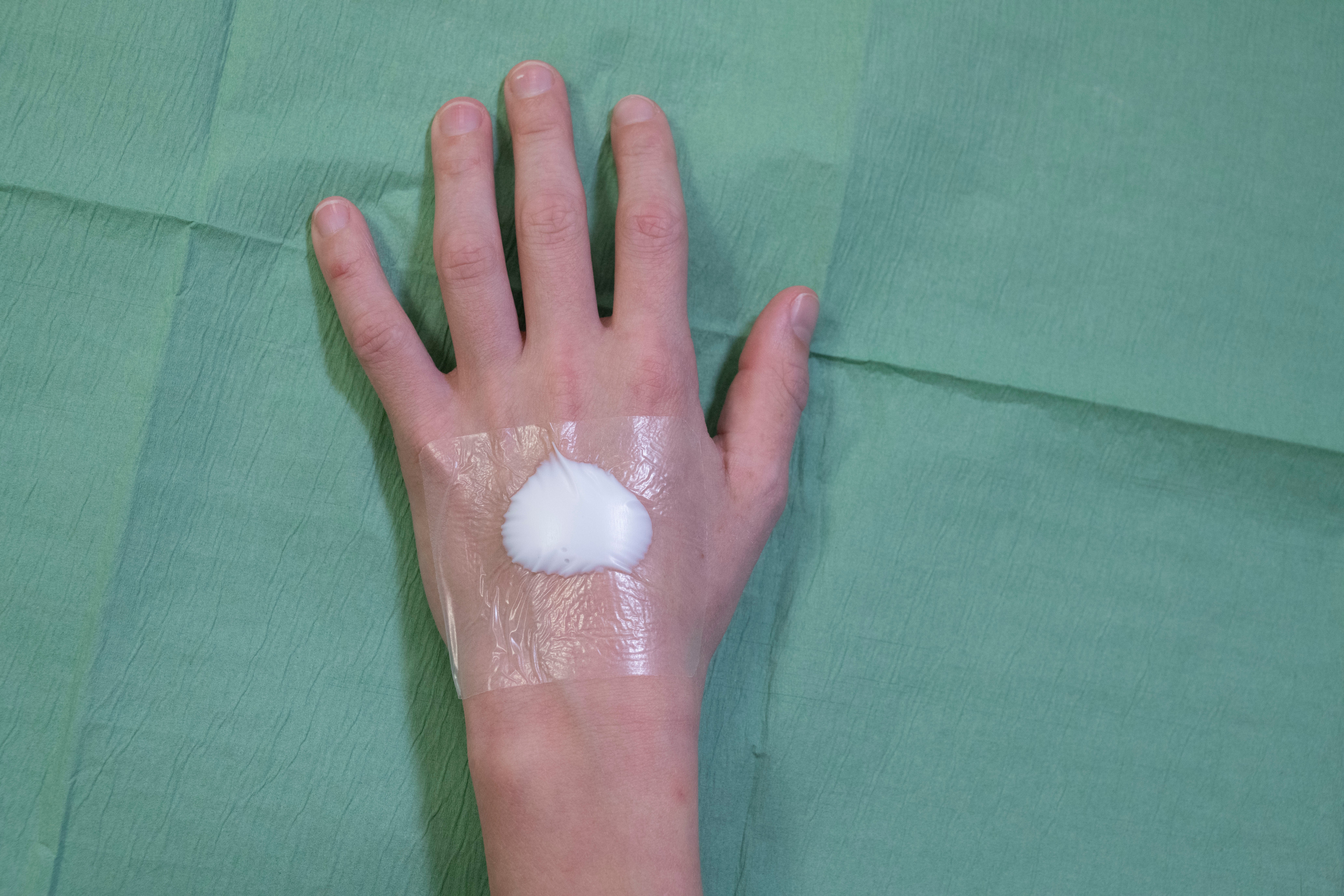 afgedekte EMLA zalf op hand