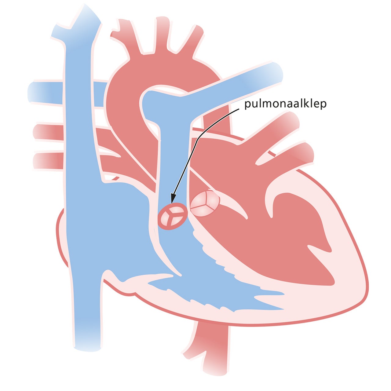 een hart met een pulmonaalklepstenose