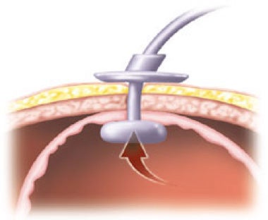 Percutane Radiologische Gastrostomie (Prg) - Umc Utrecht