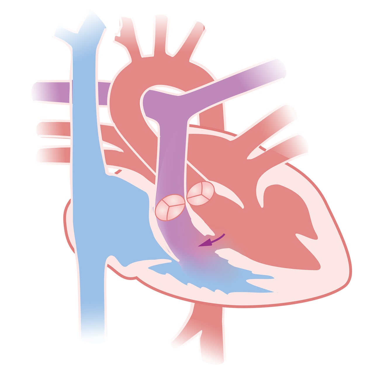 Hart met een ventrikelseptumdefect (VSD)