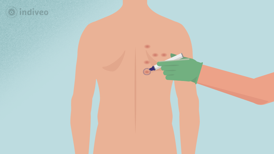 aftekenen allergieplek plakproef