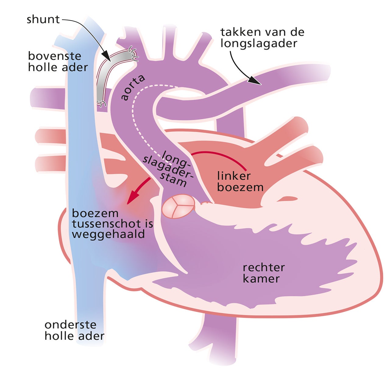 Het hart met een hypoplastisch linkerhartsyndroom na een een Norwood operatie