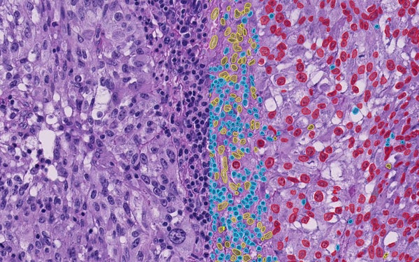 Biopsie van een melanoom met resultaten van het AI-model. In rood zijn tumorcellen, in blauw TIL's en in geel niet-tumorcellen en niet-TIL's weergegeven.