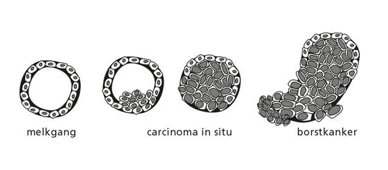 Voorstadium borstkanker - UMC Utrecht