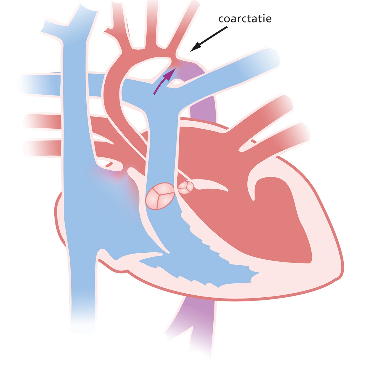 coarctatie aortae bij een pasgeborene
