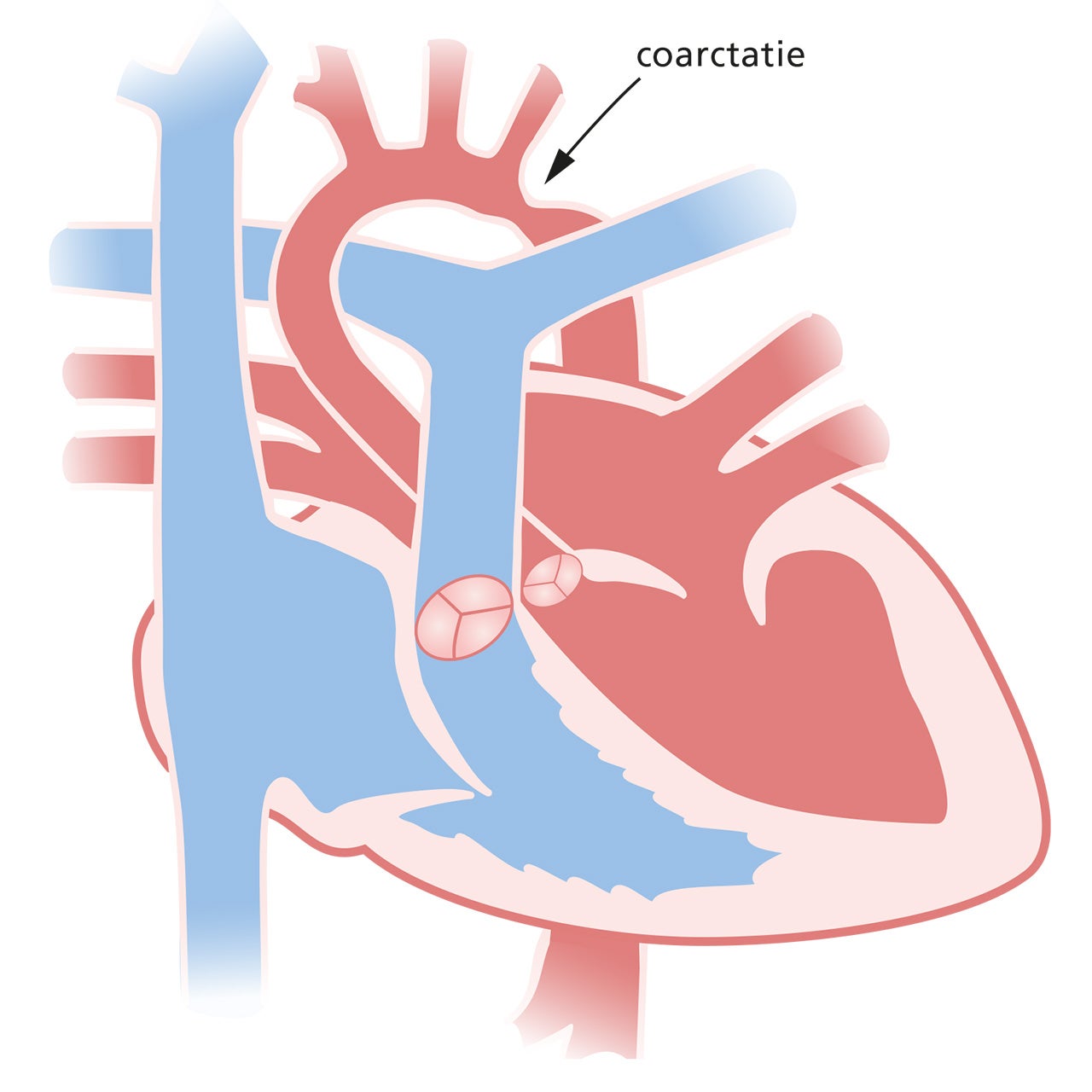 coarctatie aortae bij een jong kind