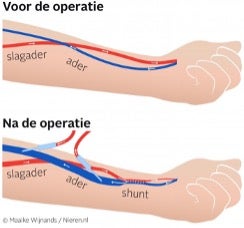 Een diagram van een menselijke arm, met de posities van de aderen uitgetekend. 