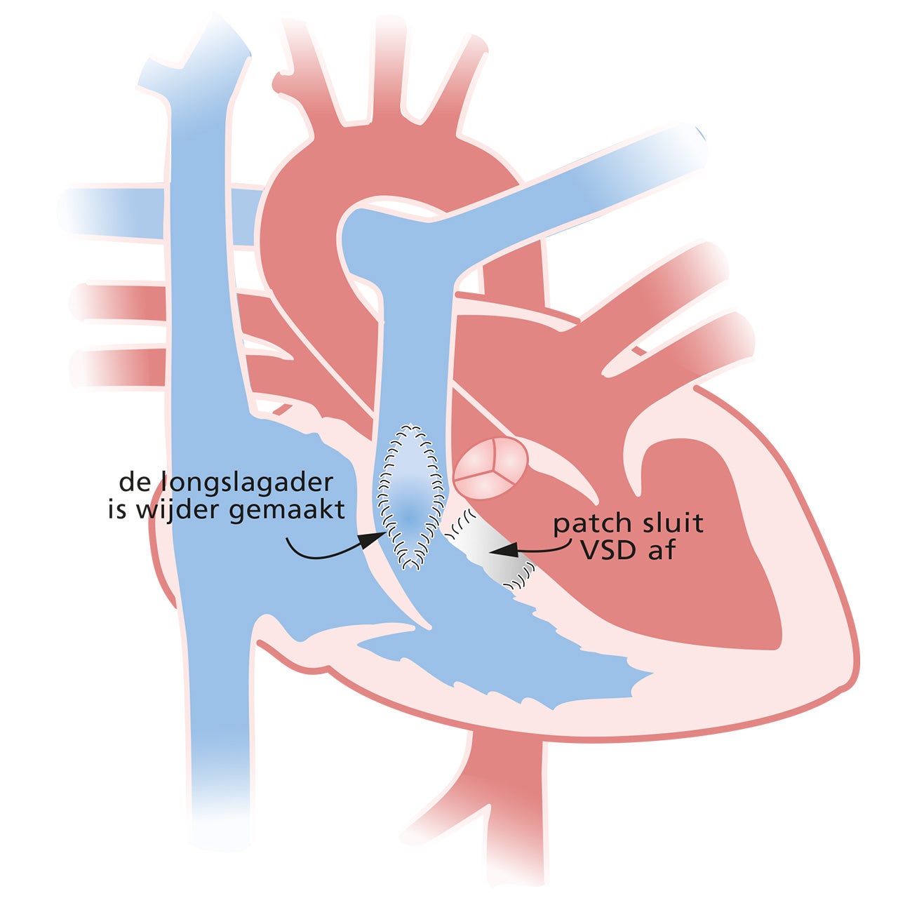 Hart met Tetralogie van Fallot na de operatie