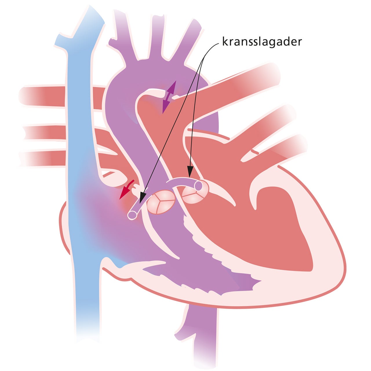hart met transpositie van de grote arteriën(TGA)