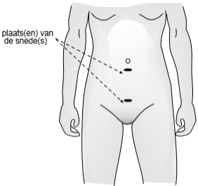 Een afbeelding waarop de plaatsen van de snedes onder de navel en boven de schaamstreek te zien zijn.