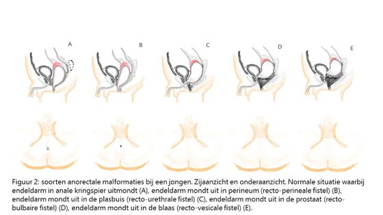 Infographic figuur 2: soorten anorectale malformaties bij een jongen. Zijaanzicht en onderaanzicht. Normale situatie waarbij endeldarm in anale kringspier uitmondt (A), endeldarm mondt uit in perineum (rectoperineale fistel) (B), endeldarm mondt uit in de plasbuis (recto-urethrale fistel) (C), endeldarm mondt uit in de prostaat (recto-bulbaire fistel) (D), endeldarm mondt ui in de blaas (recto-vesicale fistel) (E).