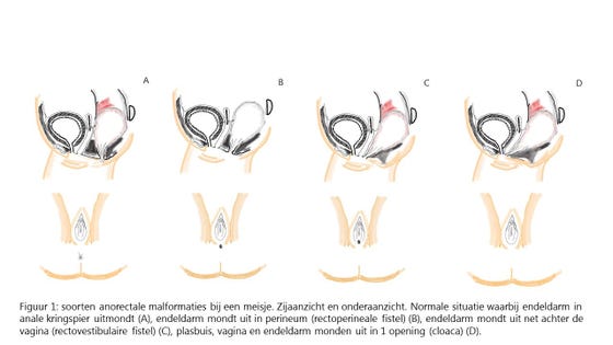 Infographic figuur 1: soorten anorectale malformaties bij een meisje. Zijaanzicht en onderaanzicht. Normale situatie waarbij endeldarm in anale kringspier uitmondt (A), endeldarm mondt uit in perineum (rectoperineale fistel) (B), endeldarm mondt uit net achter de vagina (rectovestibulaire fistel) (C), plasbuis, vagina en endeldarm monden uit in 1 opening (cloaca) (D).
