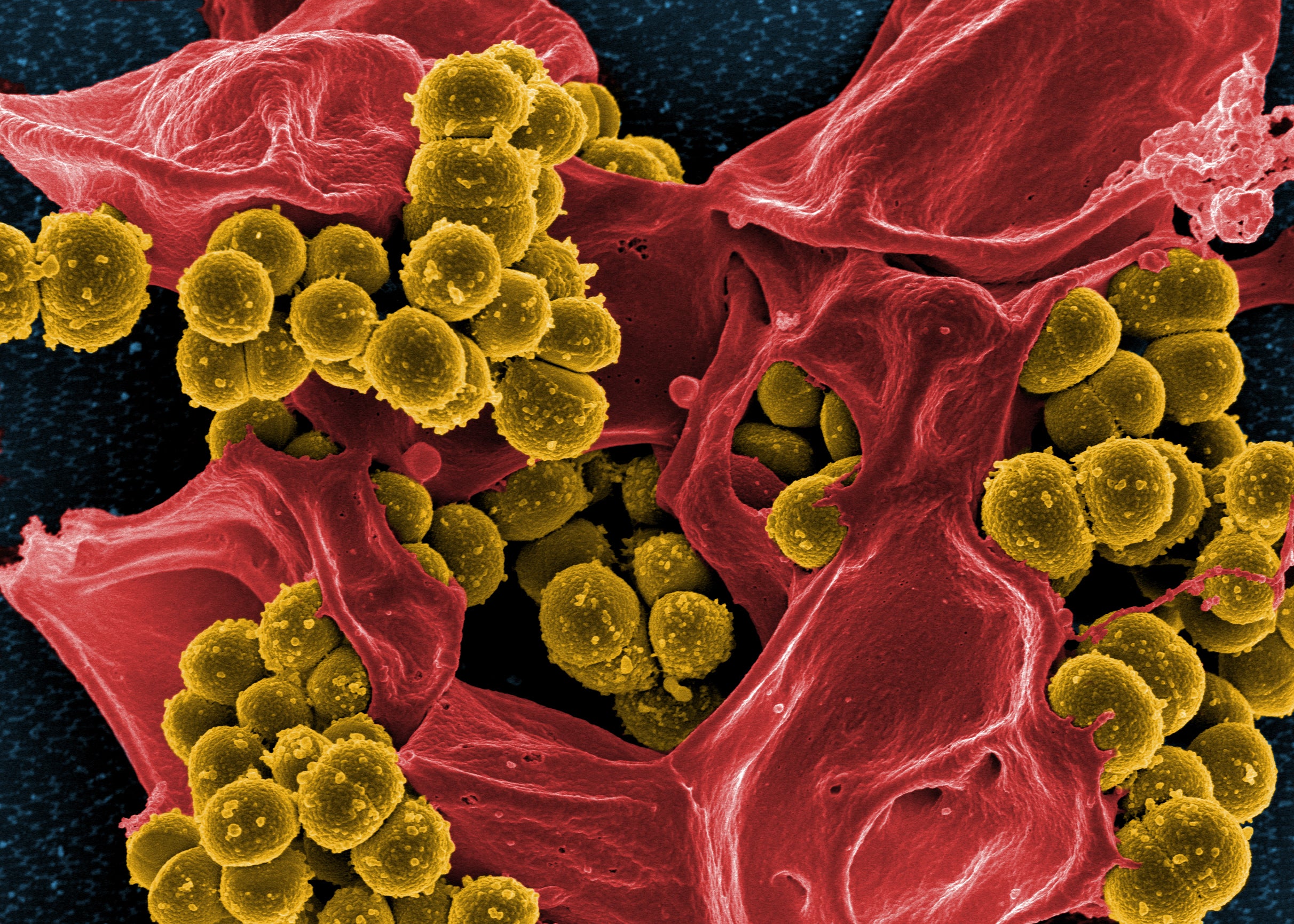 Staphylococcus aureus Infections