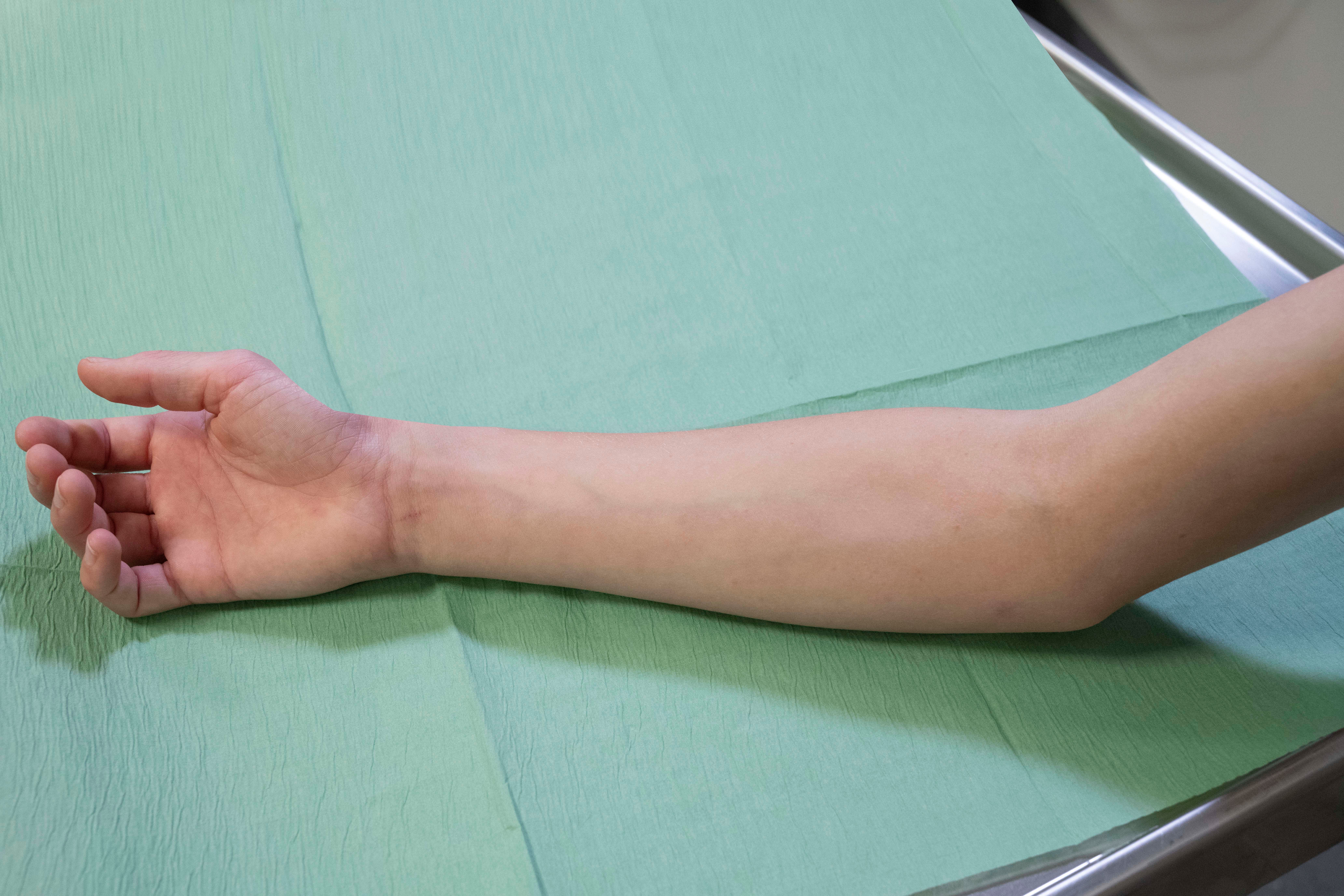 elleboog klaar voor EMLA zalf