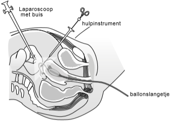 Een afbeelding waarop te zien is dat een hulpmiddel door de onderste snede geschoven kan worden.
