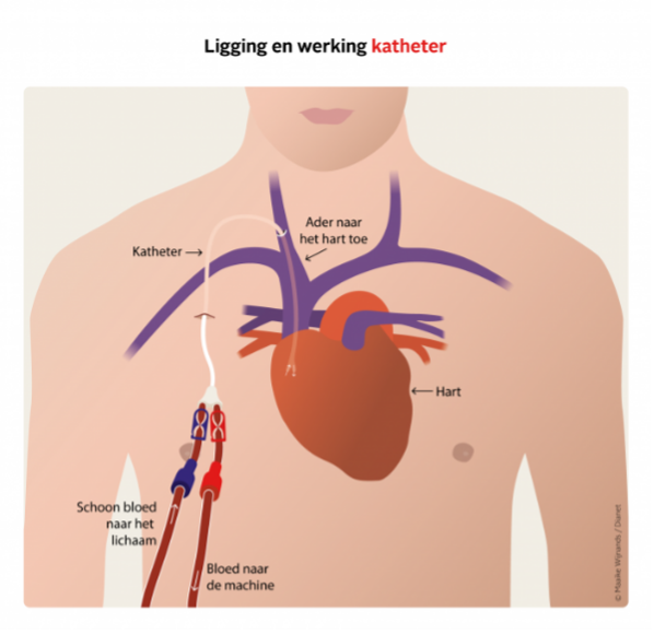 Een diagram van een menselijk hart, waarop de ligging en werking van een katheter uitgetekend staat.