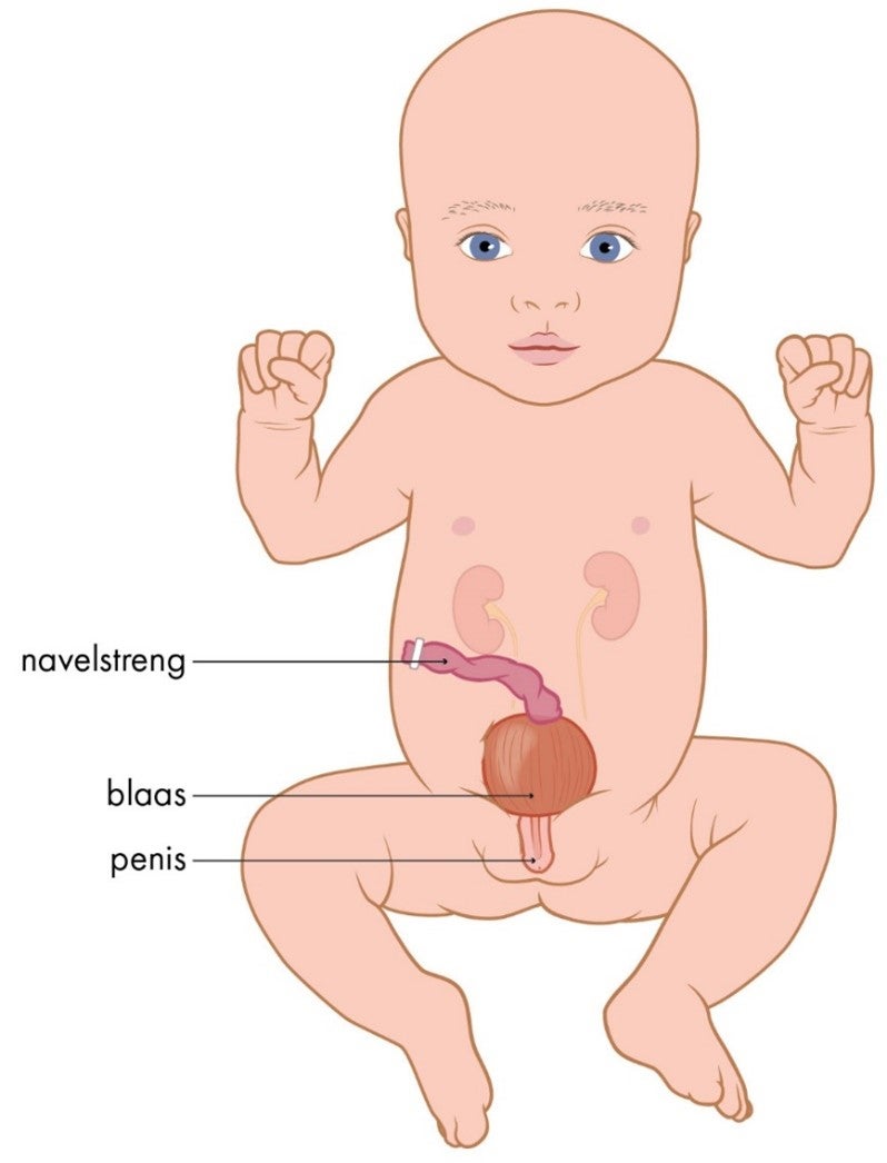 Baby jongen met blaasextrofie