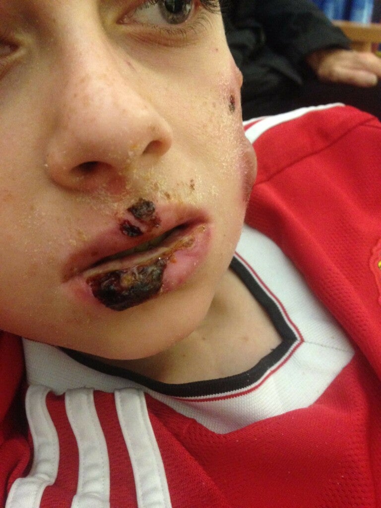 Jim mit Verletzungen am Mund und im Gesicht, die von einer Autoimmunkrankheit stammen